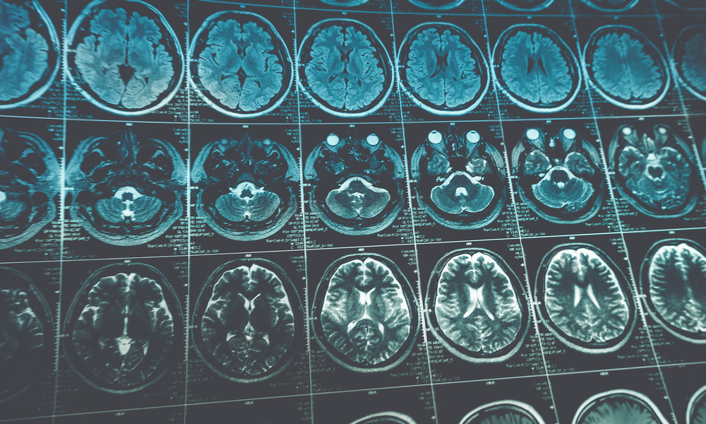 mri images of a human head